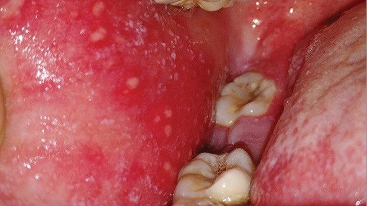 بقع كوبليك (Koplik spots)
الحصبة (Measles)