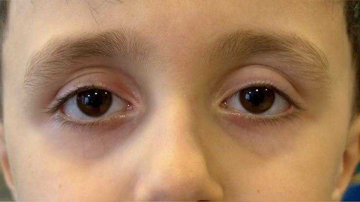 الجفاف عند الأطفال
Sunken eyes