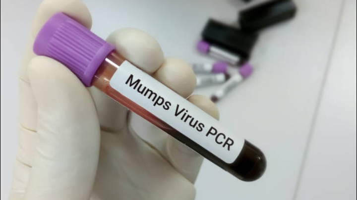 النكاف (Mumps)