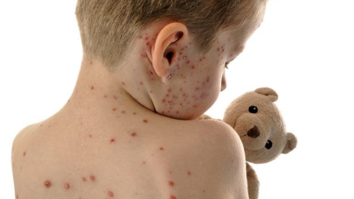 الحصبة (Measles)