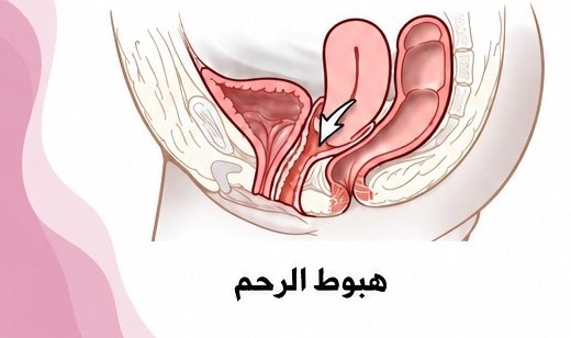 انقلاب الرحم